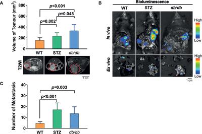 Transcriptomic Analyses and Potential Therapeutic Targets of Pancreatic Cancer With Concomitant Diabetes